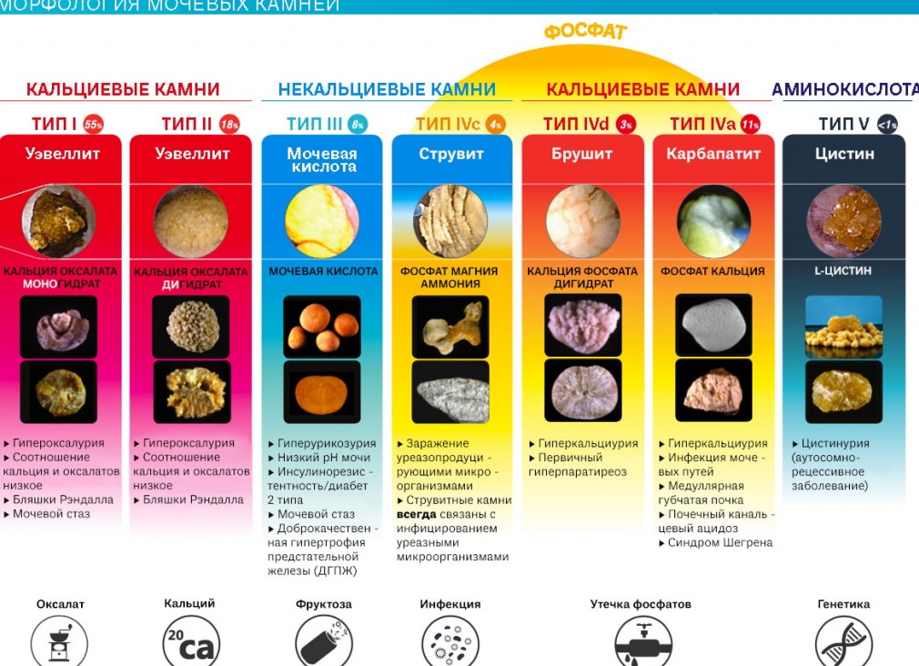 Из-за каких продуктов появляются камни в почках