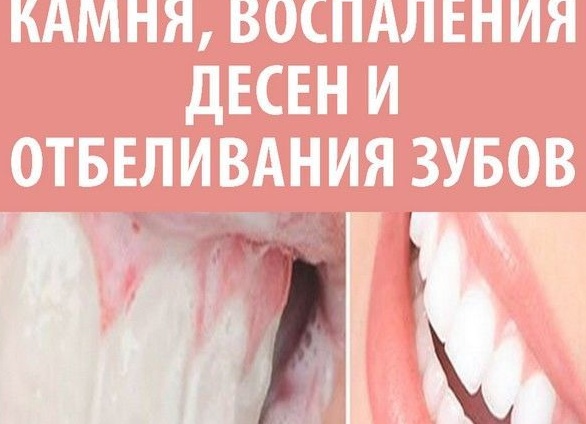 Полезные продукты для растворения камней в желчном пузыре